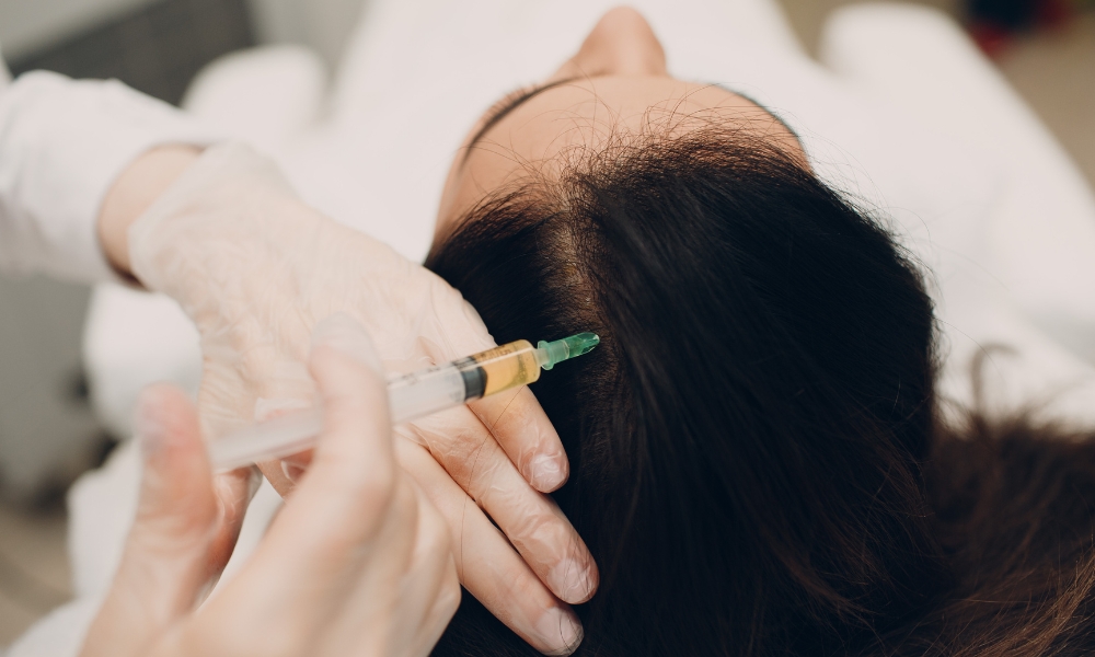 mezoterapija vlasišta