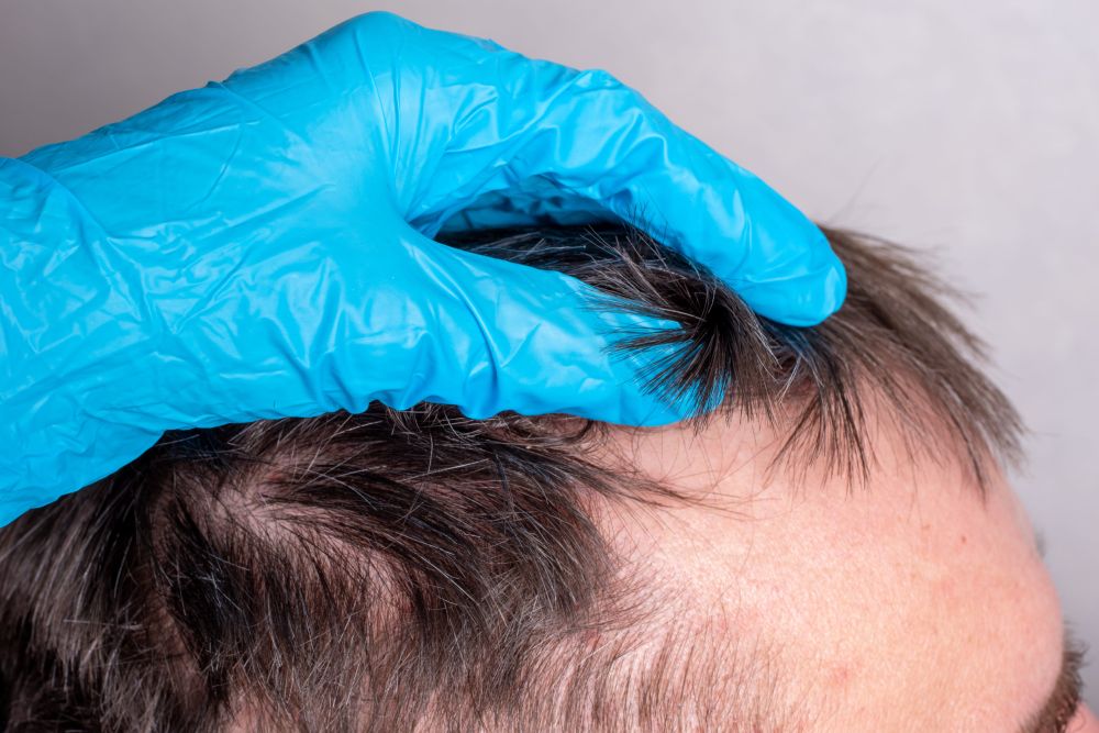 Dermatološki pregled vlasišta osobe sa proređenom kosom i povlačenjem linije kose na čelu